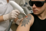Tattoo verwijderen met laser: alles wat je moet weten